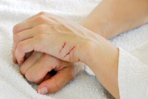 Foto de mão com dois arranhões antes da cicatrização da pele