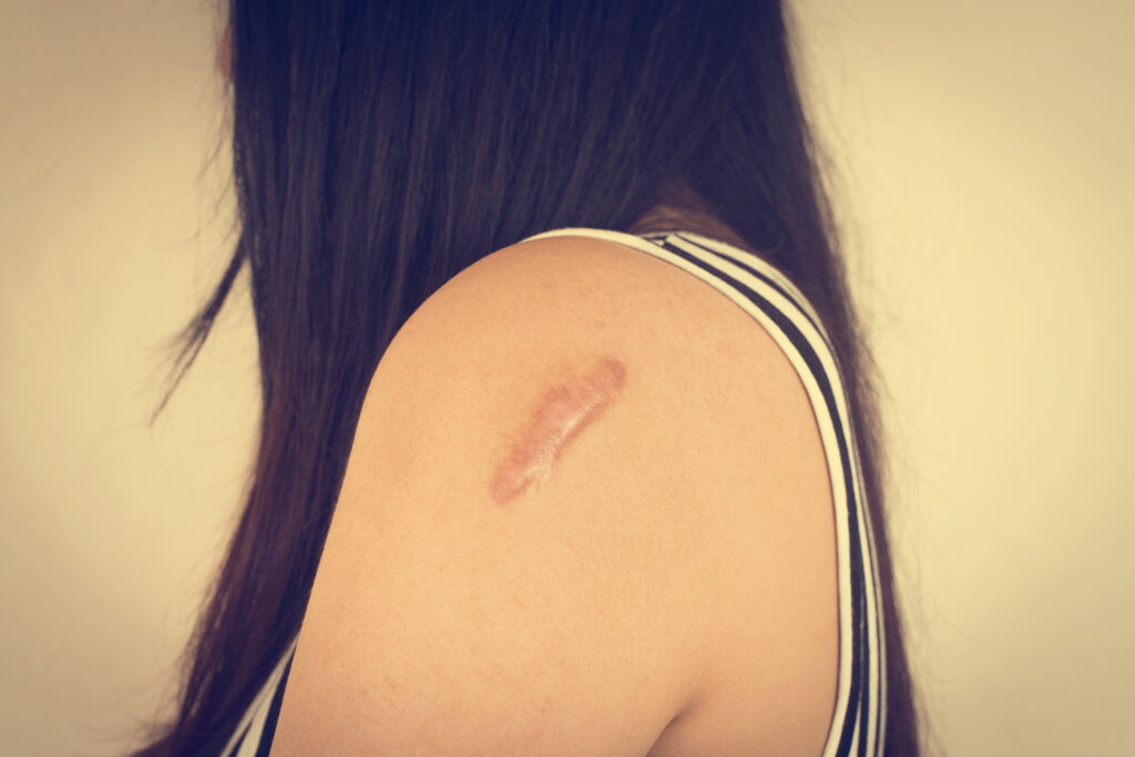 Foto de cicatriz em ombro de mulher