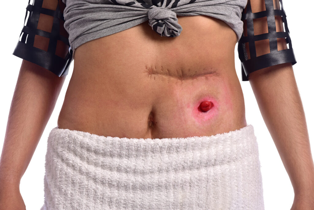 Foto das cicatrizes de um paciente ostomizado