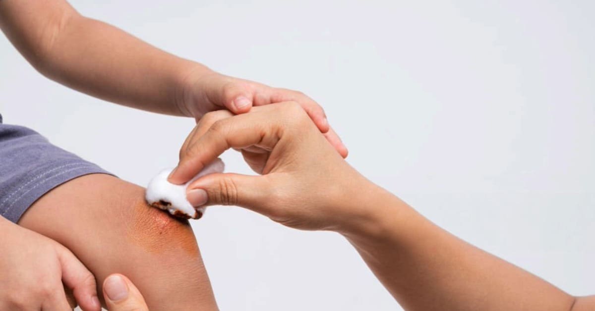 Como fazer a limpeza correta da lesão?