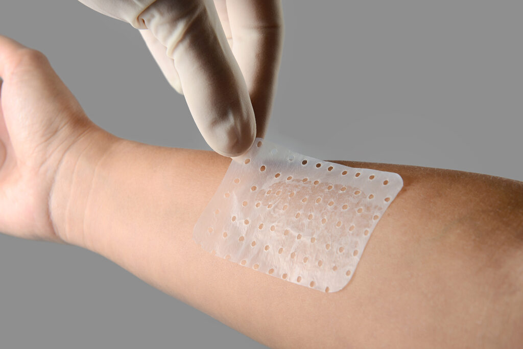 Foto da aplicação de um curativo Membracel em pele lesionada