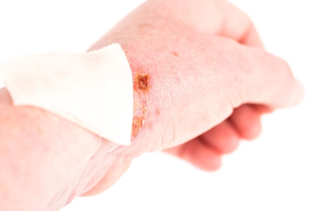 Ferida Esbranquiçada: Causas, Tratamentos e Cuidados