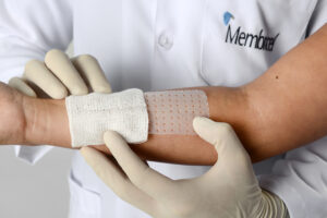 Enfermeiro aplicando a membrana regeneradora porosa membracel em lesão no braço