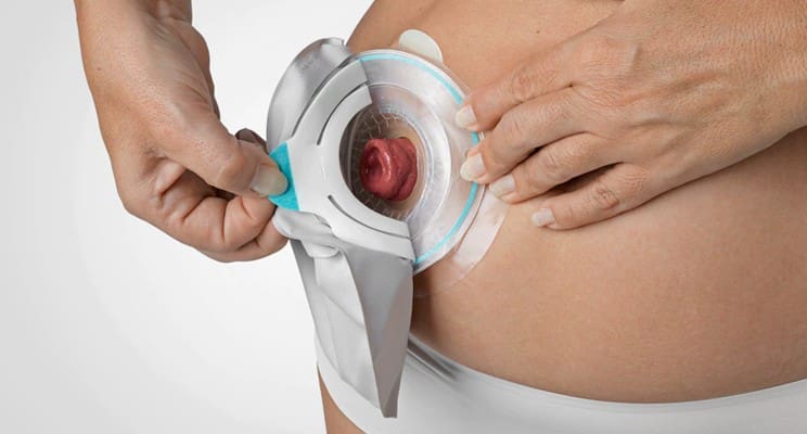 O que é ostomia