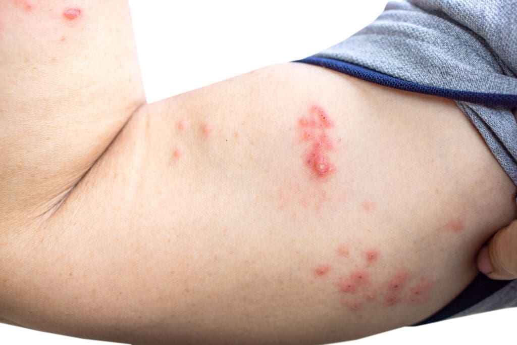 Dermatite Bolhosa: Guia Completo de Tratamento e Prevenção