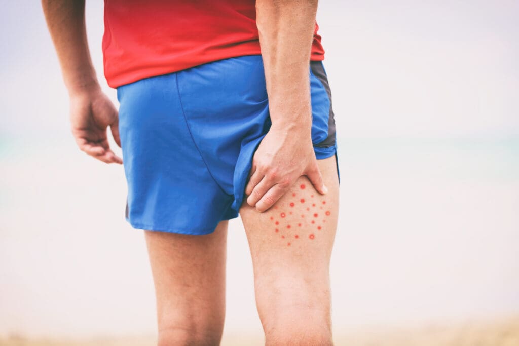 Dermatite Bolhosa: Guia Completo de Tratamento e Prevenção