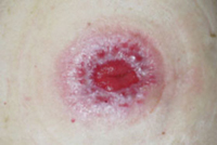 Granuloma em estomia