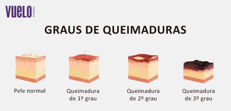 Como identificar o grau de uma queimadura? - Vuelo Pharma