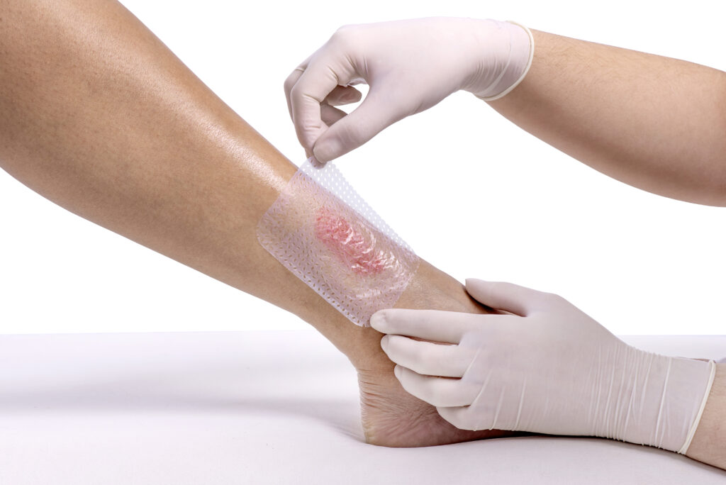 enfermeiro aplicando a membrana regeneradora porosa membracel na perna de paciente
