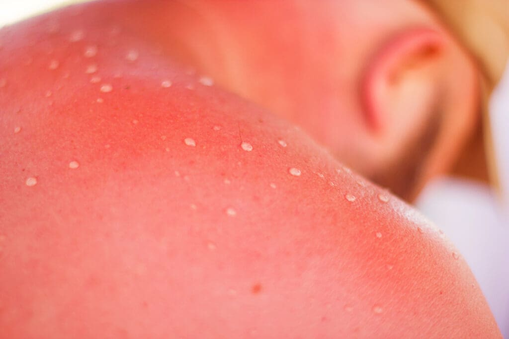 Queimaduras do Sol: Cuidados e Como Curar