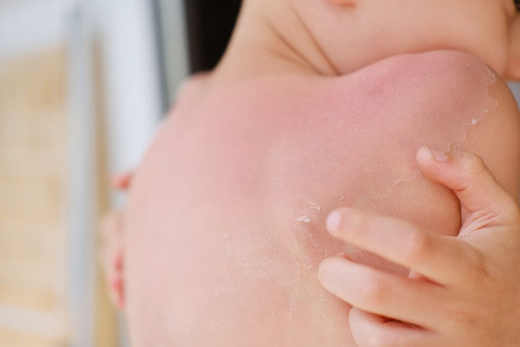 Queimaduras do Sol: Cuidados e Como Curar