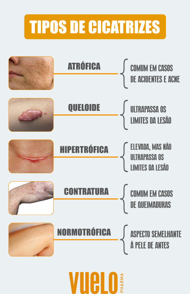 Infográfico sobre os tipos de cicatrizes (atrófica, queloide, hipertrófica, contratura e normotrófica)