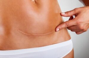 Cuidados com cicatrizes cicatriz na barriga
