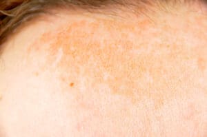 Diferenças entre Dermatose e Dermatite