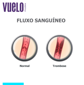 Úlcera varicosa e trombose Ilustração de trombose