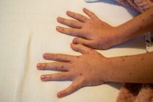 Anemia falciforme: O que é, tratamento e causas