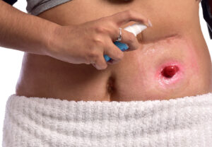 O que é ileostomia? Aplicação do Spray de Barreira