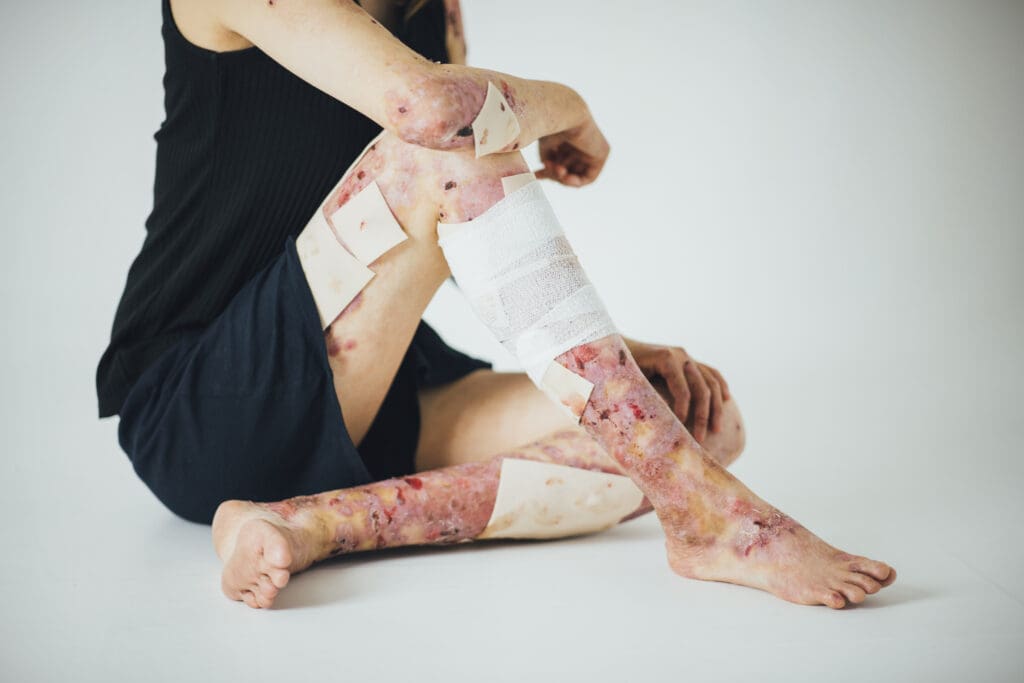 Epidermólise bolhosa é contagiosa?