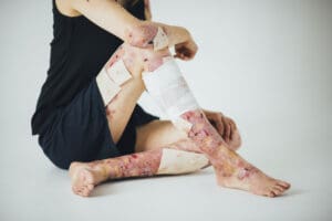 Epidermólise bolhosa é contagiosa?