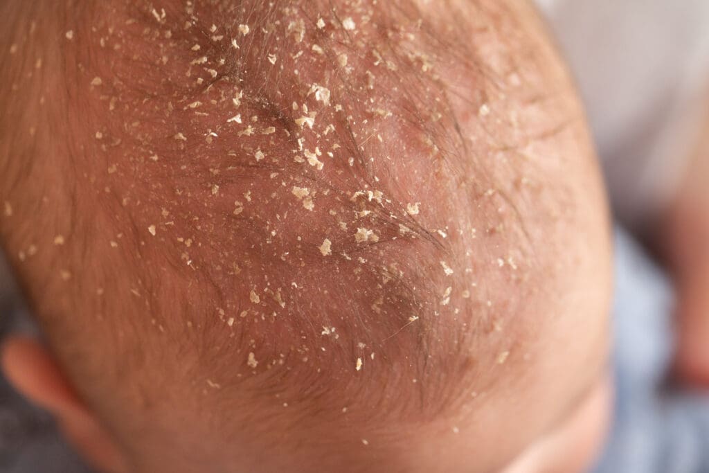 Conheça os 6 Principais Tipos de Dermatites