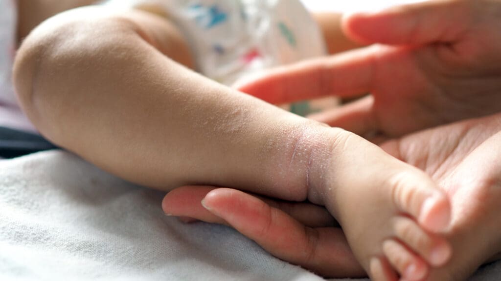 Conheça os 6 Principais Tipos de Dermatites