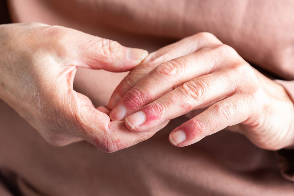 Conheça os 6 Principais Tipos de Dermatites