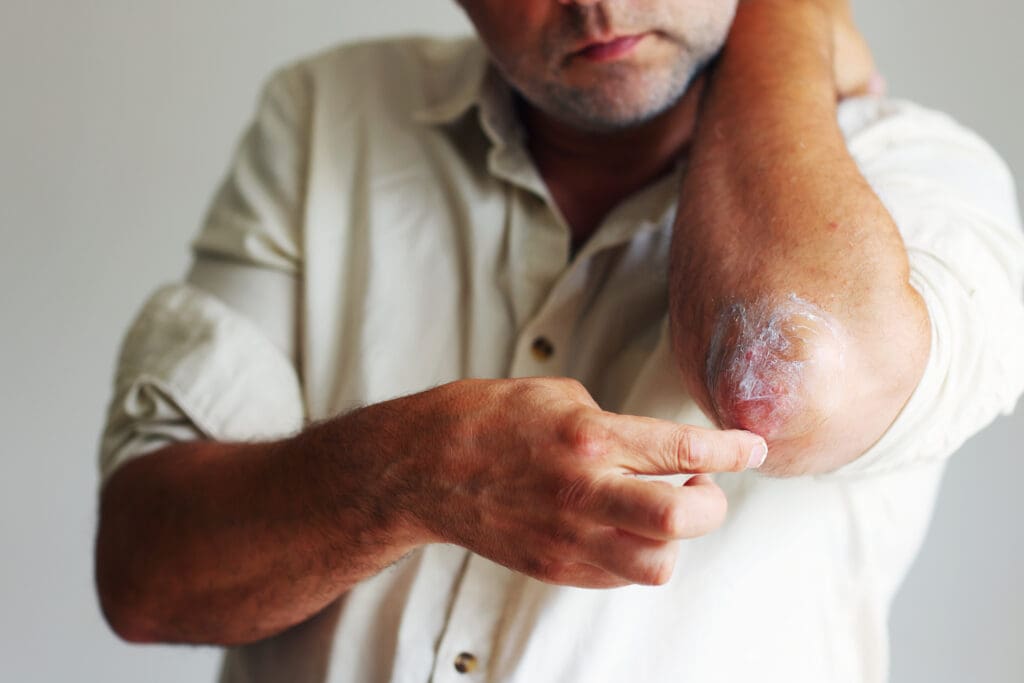 Conheça os 6 Principais Tipos de Dermatites