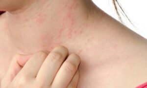 Dermatite causa coceira e descamação