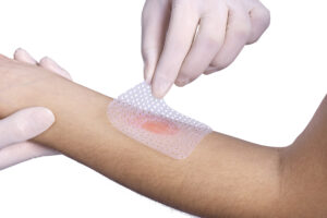 Doenças raras: Epidermólise Bolhosa Aplicação de Membracel em lesão de epidermólise bolhosa