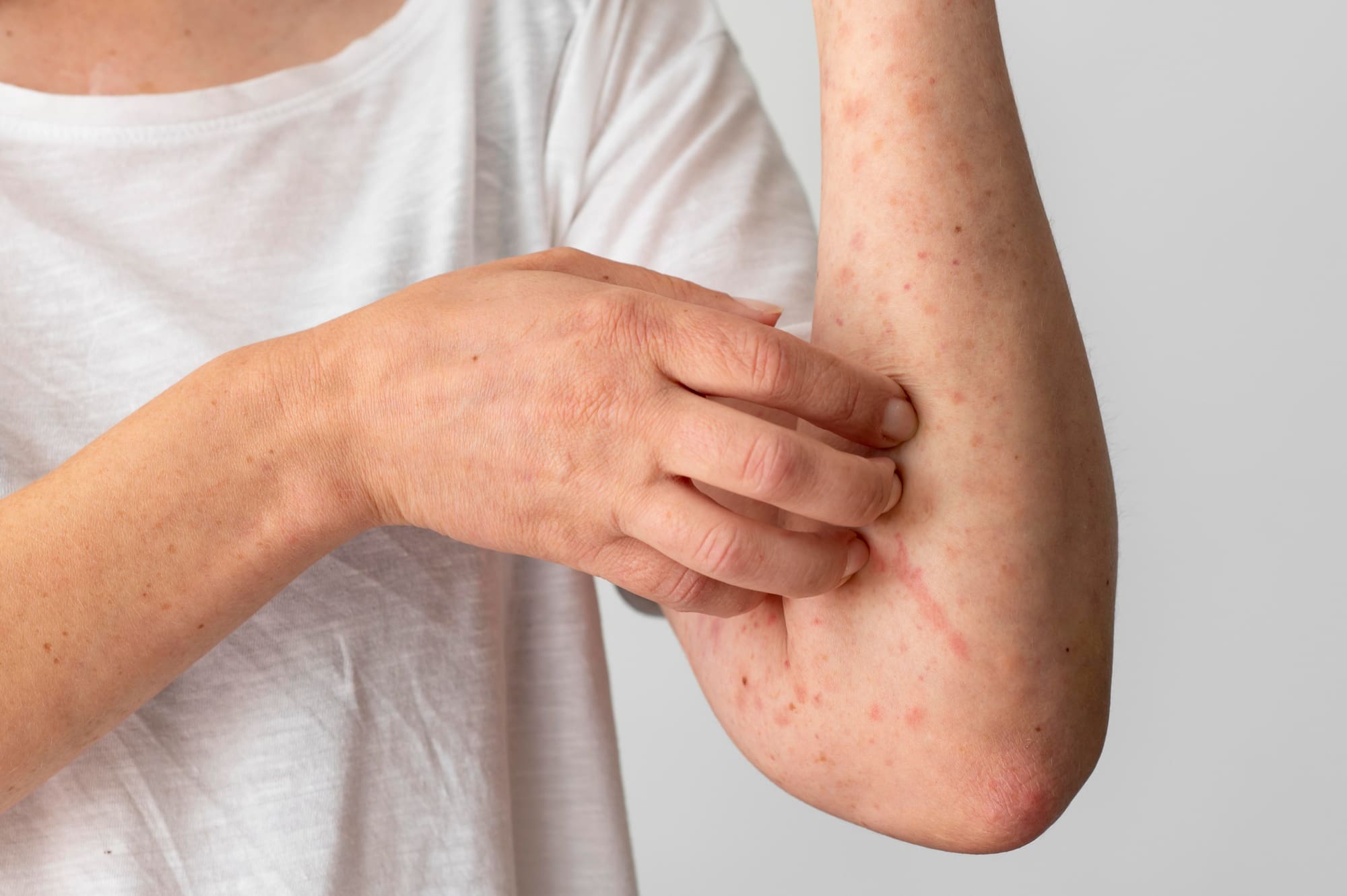 Reação alérgica cutânea no braço da pessoa