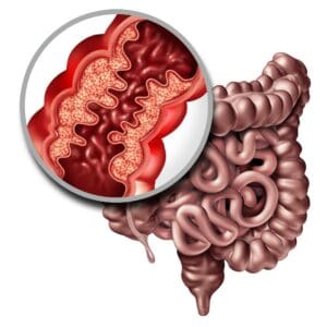 Obstrução Intestinal: o que é, sintomas e tratamento