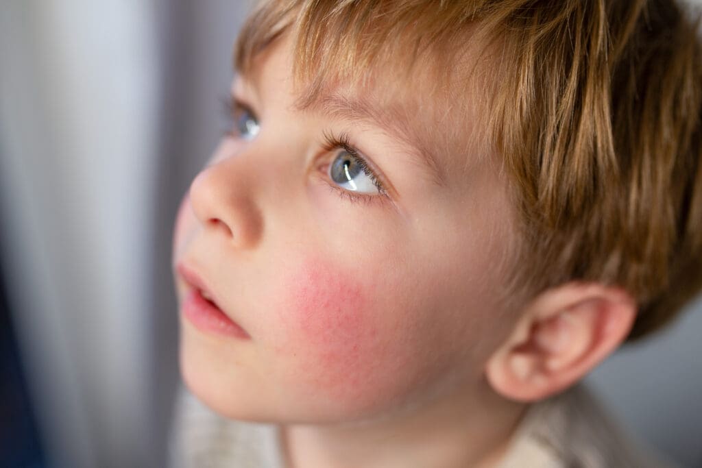 Dermatite Atópica em Bebê: Causas e Tratamentos