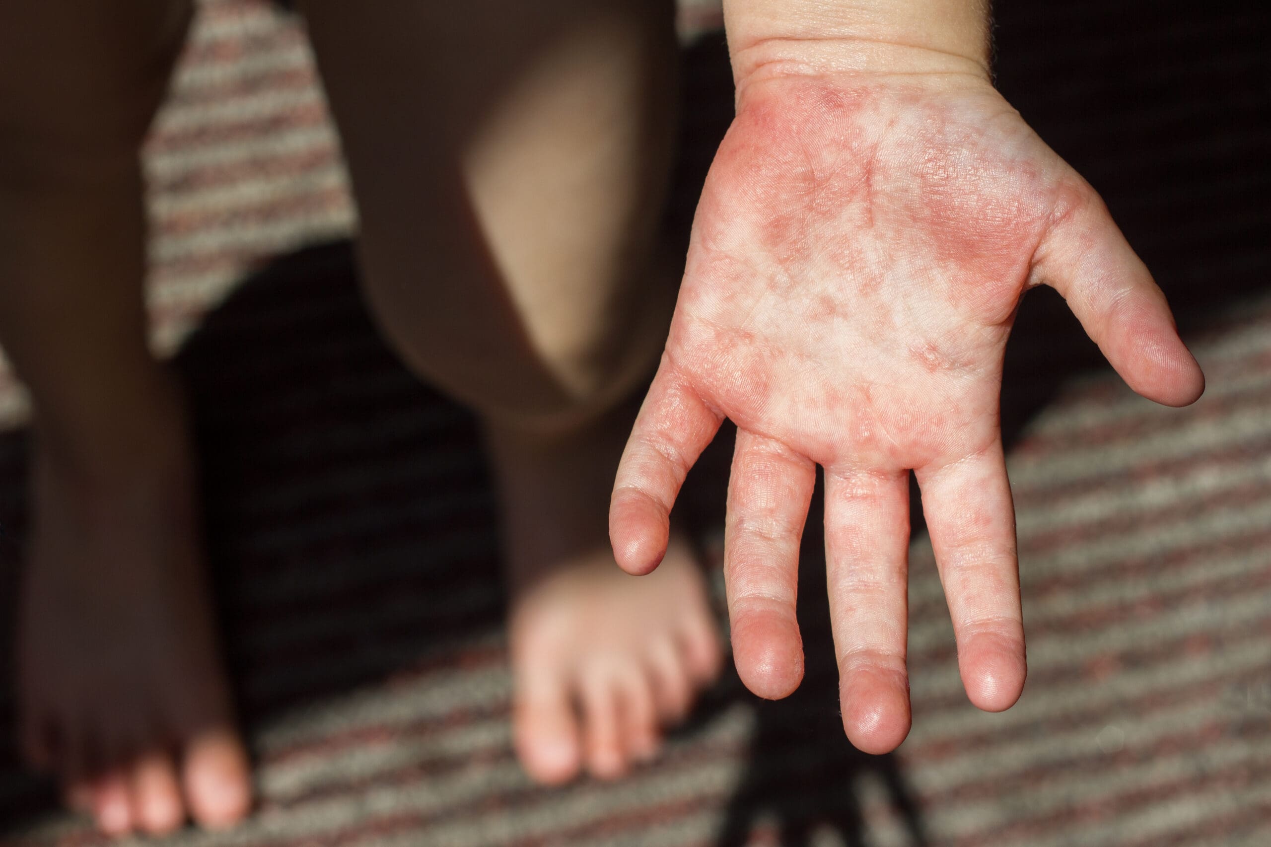 Dermatite Atópica em Bebê: Causas e Tratamentos