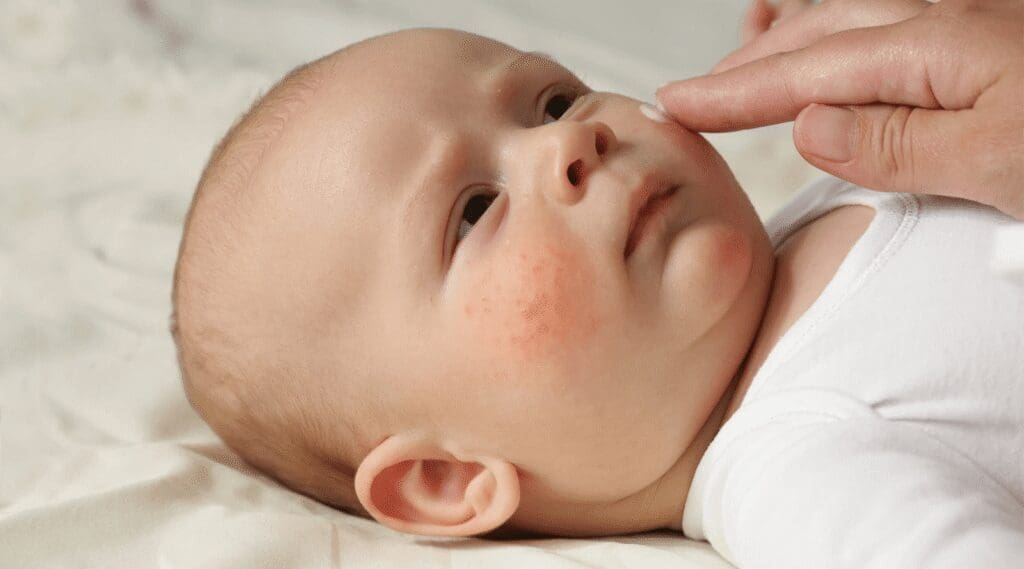 Dermatite Atópica em Bebê: Causas e Tratamentos