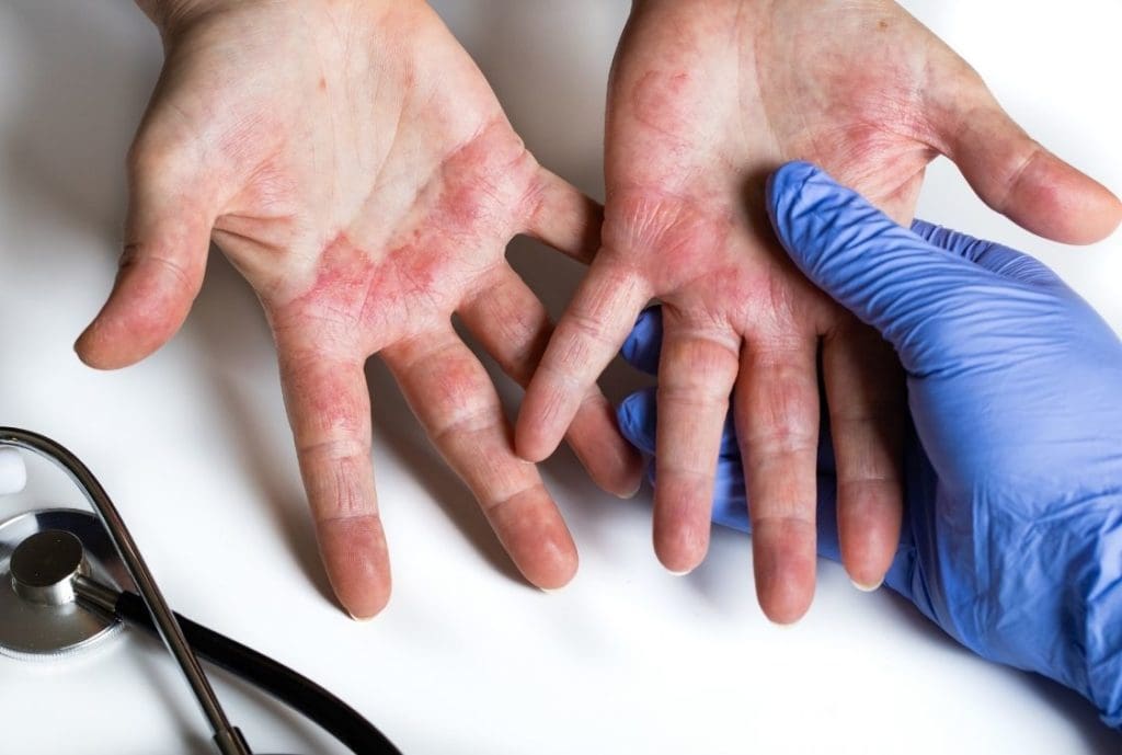 Tratamento e Prevenção de Disidrose no Pé