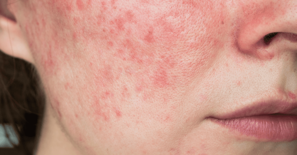 Aprenda a diferença entre psoríase, eczema e rosácea