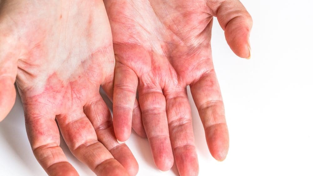 Aprenda a diferença entre psoríase, eczema e rosácea