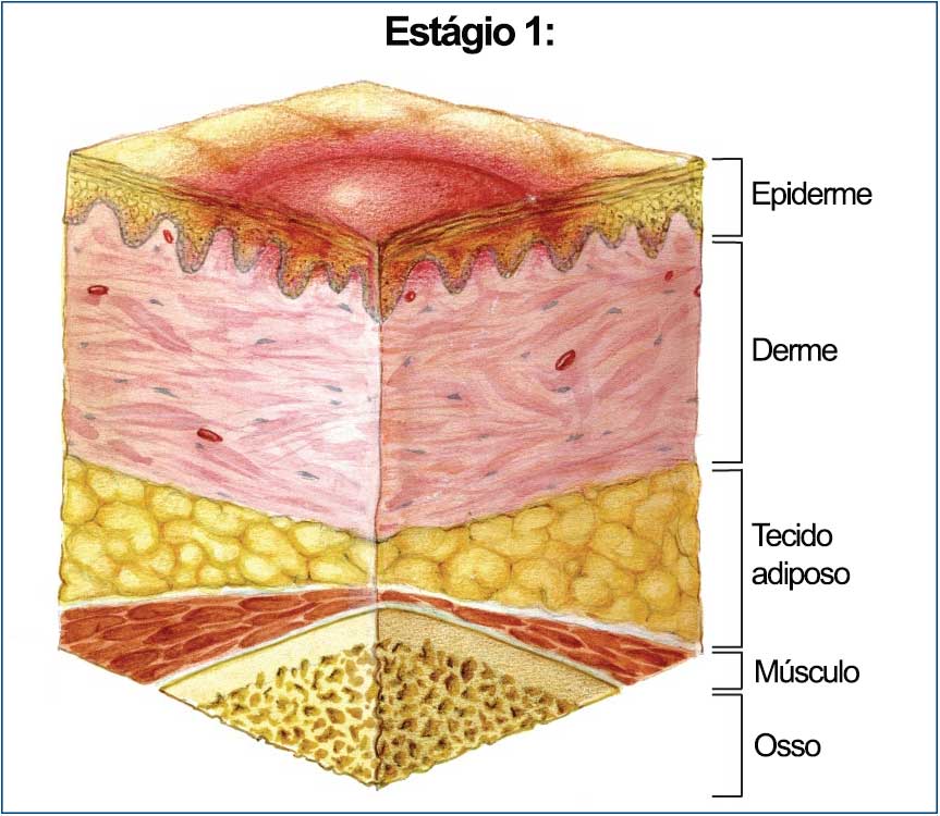 Úlceras por Pressão: Prevenção e Tratamento