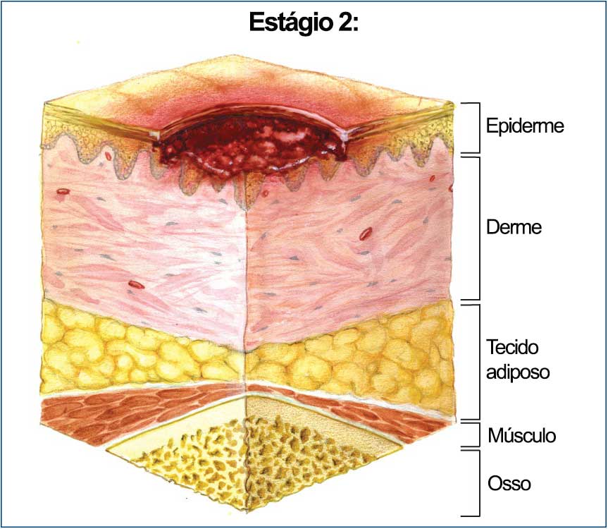 Úlceras por Pressão: Prevenção e Tratamento