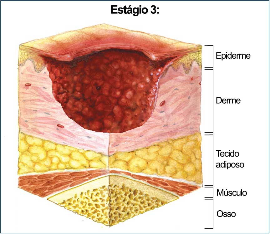 Úlceras por Pressão: Prevenção e Tratamento