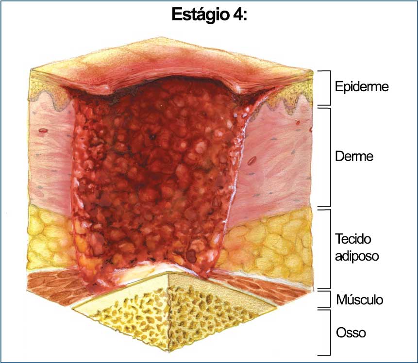 Úlceras por Pressão: Prevenção e Tratamento