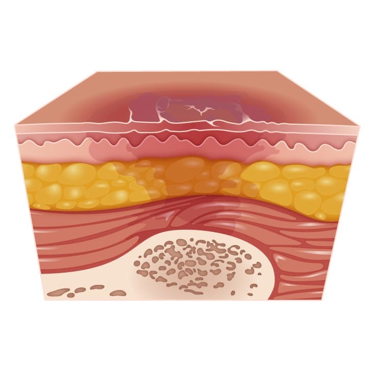 Úlceras por Pressão: Prevenção e Tratamento