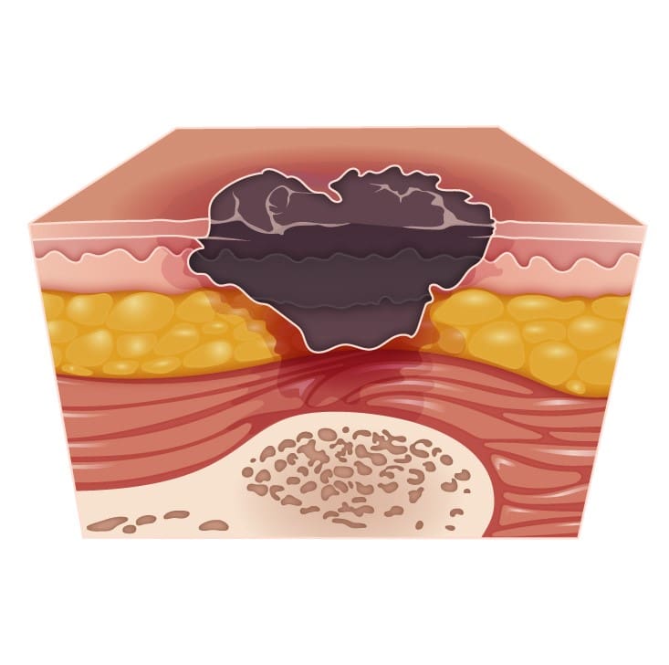 Úlceras por Pressão: Prevenção e Tratamento