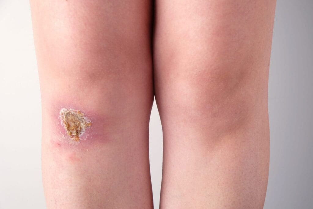Diferença Entre Infecção e Inflamação: Explicação Simples