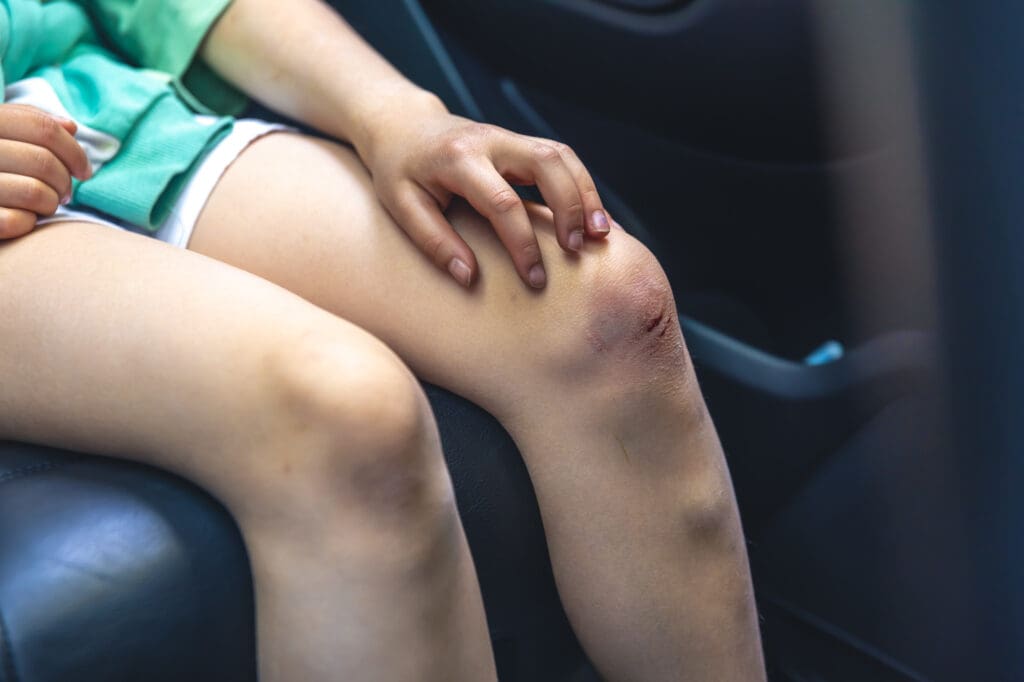Ralado de Asfalto: Dicas para Cicatrização Rápida e Segura
