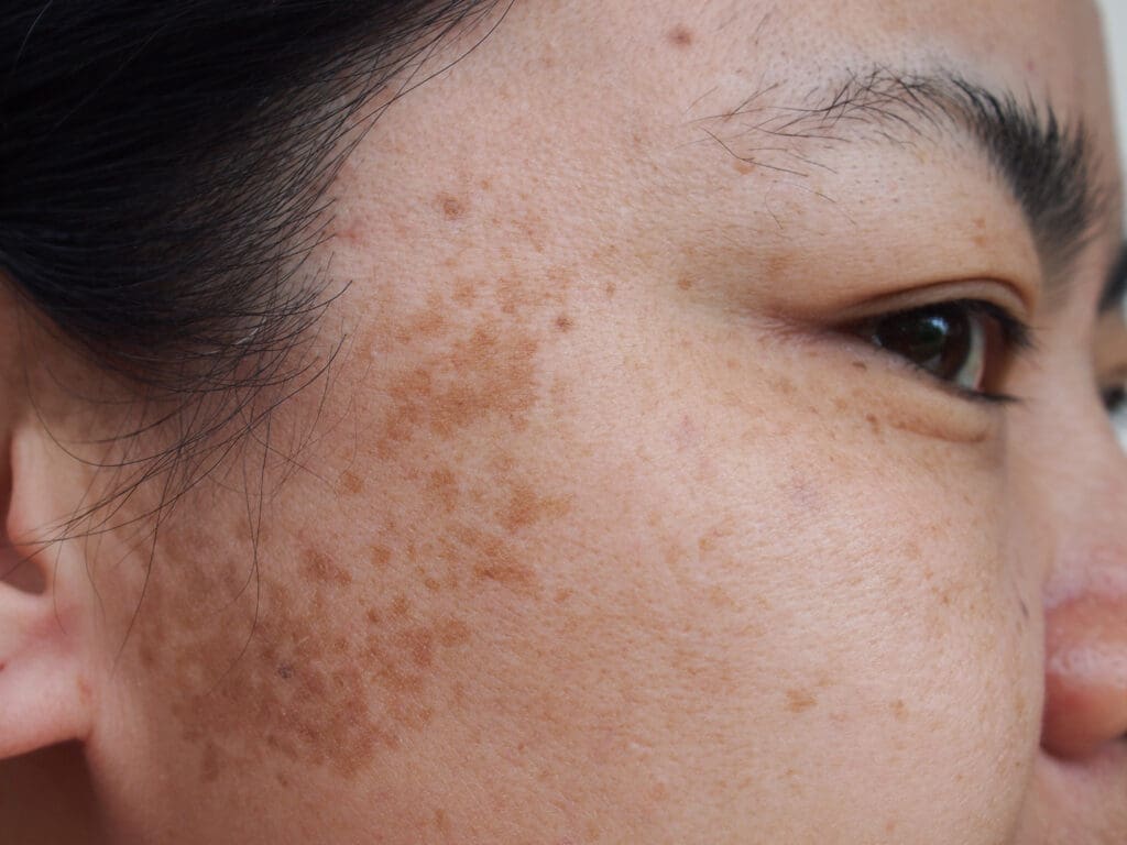 Melasma: O Que é, Causas e Tratamentos
