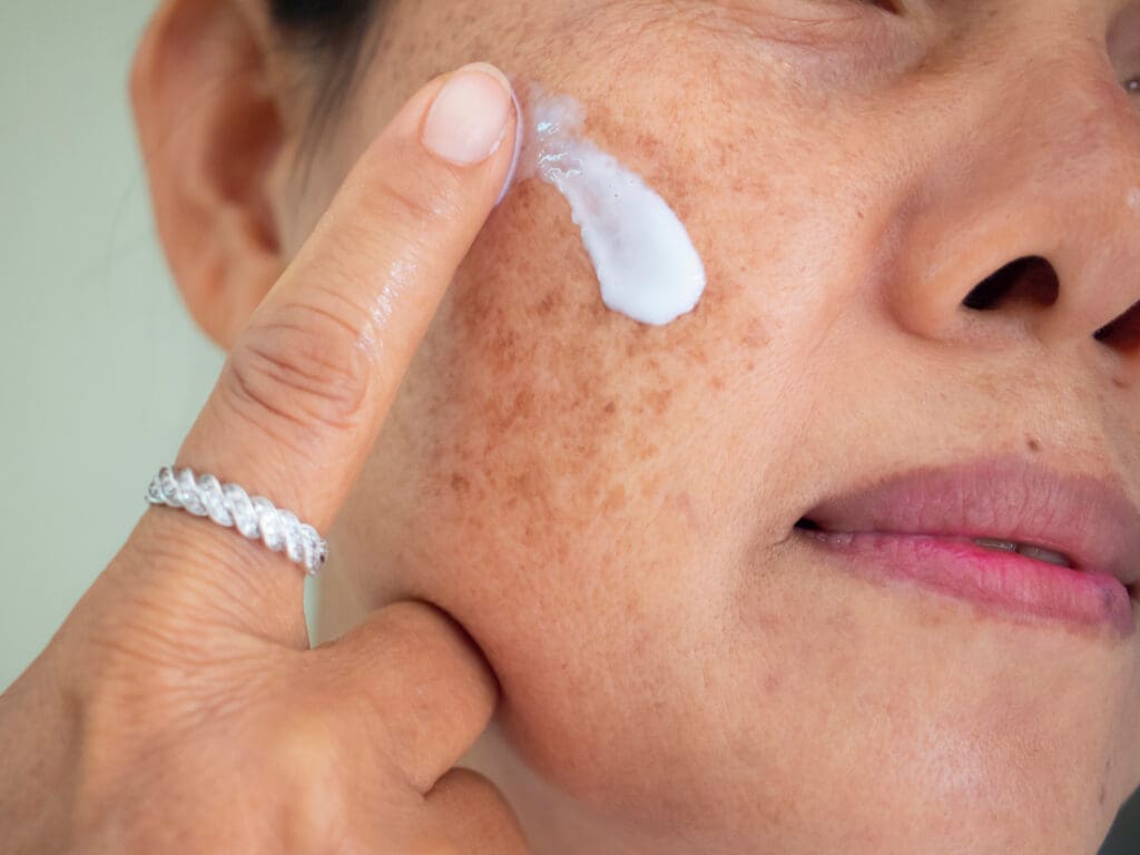 Melasma: O Que é, Causas e Tratamentos