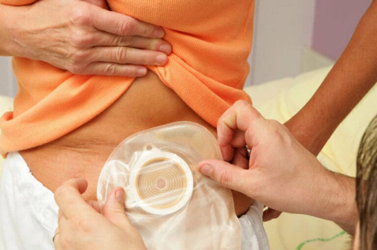 O que é Ostomizado: Entenda a Condição e os Cuidados