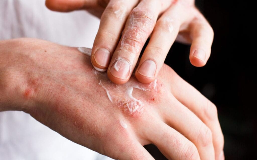 O Que é Impetigo? Saiba Tudo Sobre a Infecção
