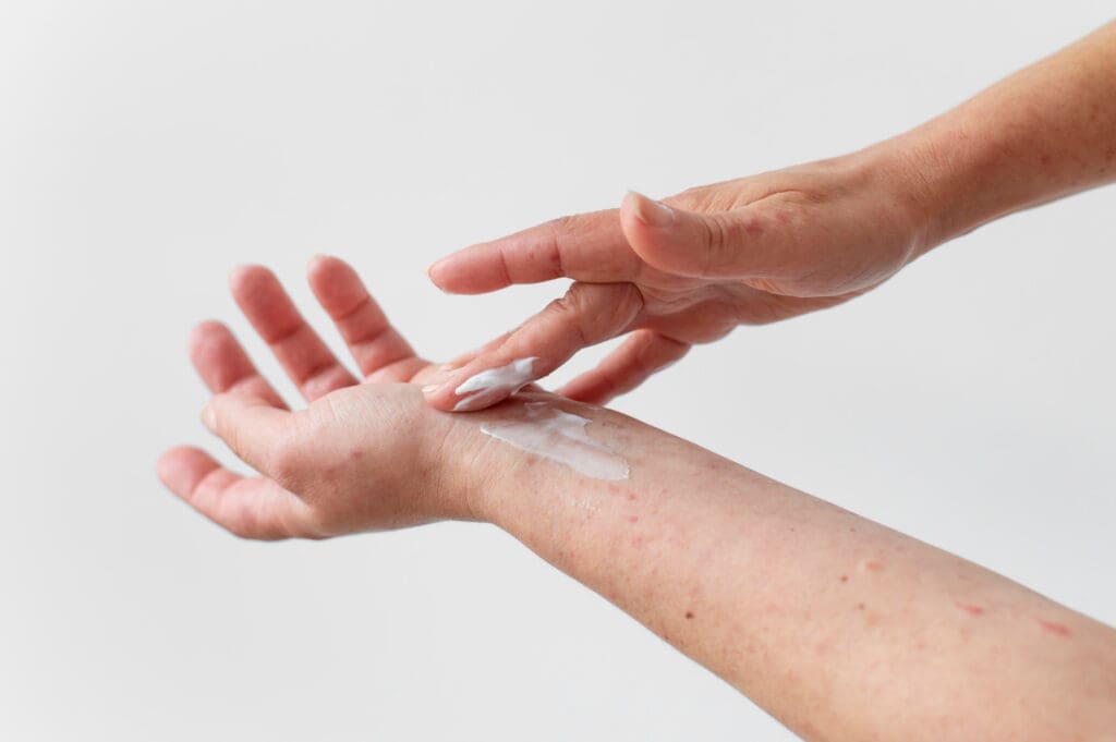Eczema: Tipos, Sintomas e Como Tratar